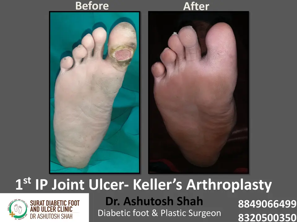 Diabetic Foot  PPT 3 checked by sir.pptx-41.webp